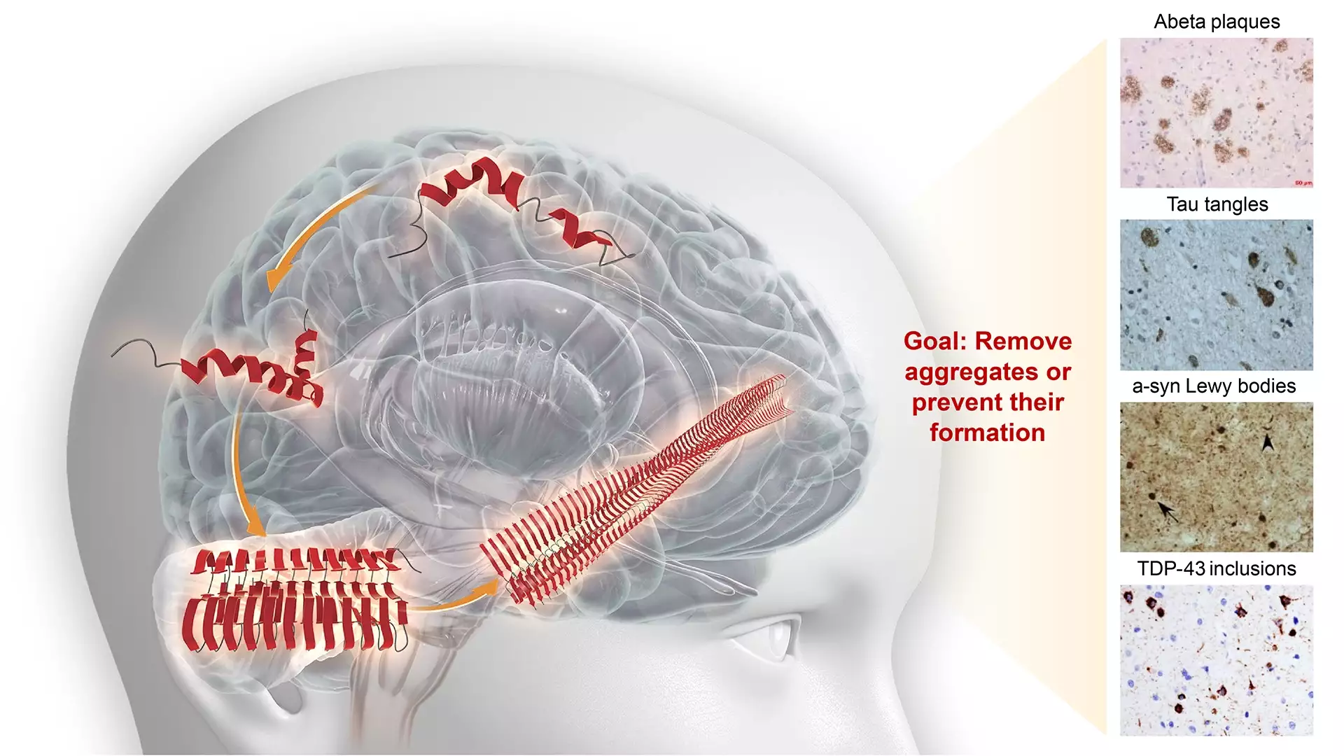 AC Immune Therapeutic focus misfolded proteins | Pioneering Precision Medicine for neurodegenerative diseases