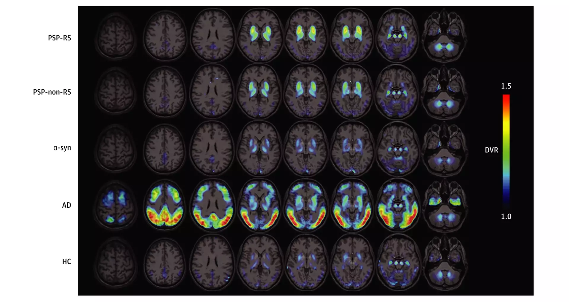 AC Immune Technology Platforms Brendel figure | Pioneering Precision Medicine for neurodegenerative diseases